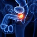 Understanding Prostate Cancer Risk and Testosterone Replacement Therapy